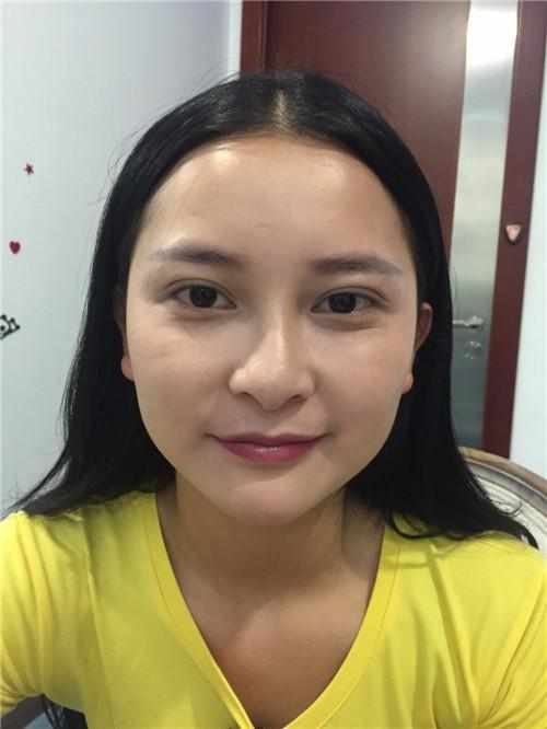 鄭州華領醫(yī)療美容醫(yī)院醫(yī)生張永濤做硅膠假體隆鼻怎么樣？附案例效果對比圖