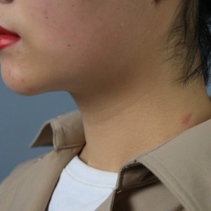 上海名媛醫(yī)療整形醫(yī)生閆嬌君做嗨體去頸紋效果怎么樣？附案例效果圖