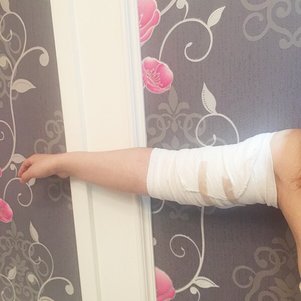 岳陽愛思特醫(yī)療美容醫(yī)院醫(yī)生王福生做手臂吸脂怎么樣？附案例效果圖