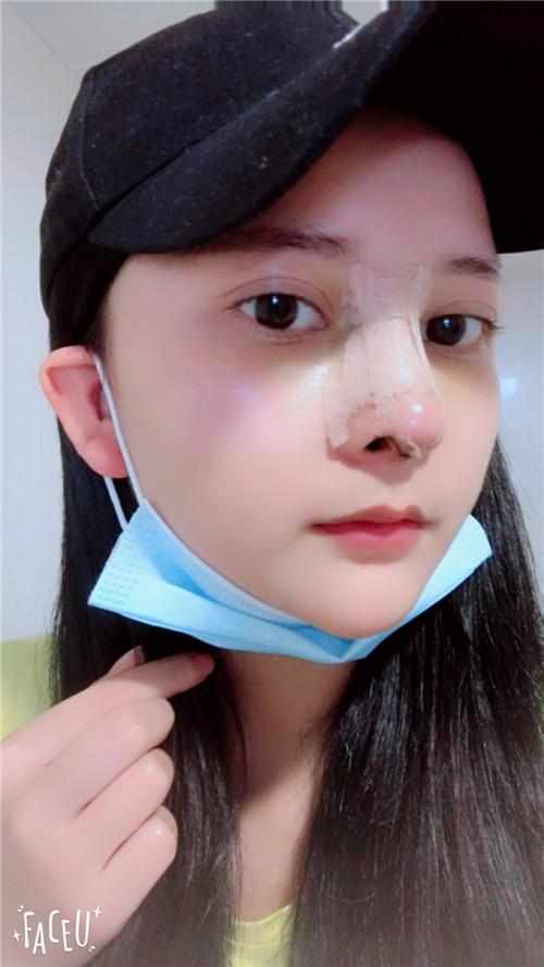 鄭州華領醫(yī)療美容醫(yī)院醫(yī)生張永濤做硅膠假體隆鼻怎么樣？附案例效果對比圖