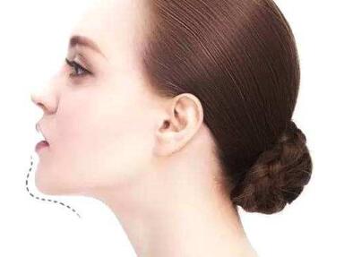 重慶忠文整形假體隆下巴