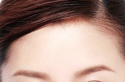 鄭州瑞亞整形自體脂肪豐額頭