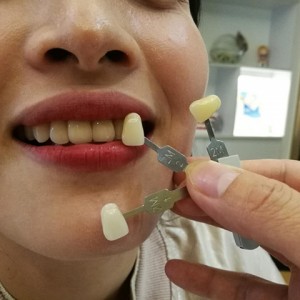 上海科瓦口腔醫(yī)院醫(yī)生鄧建儒做牙齒冷光美白怎么樣？附案例效果對(duì)比圖