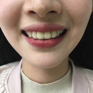 上海科瓦口腔醫(yī)院醫(yī)生鄧建儒做牙齒冷光美白怎么樣？附案例效果對(duì)比圖