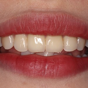 上海科瓦口腔醫(yī)院醫(yī)生鄧建儒做牙齒冷光美白怎么樣？附案例效果對(duì)比圖