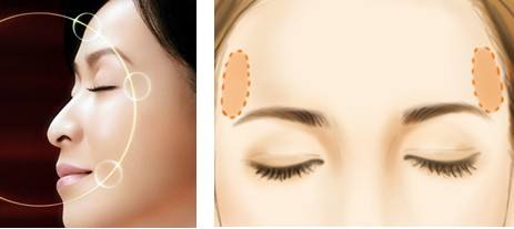 珠海仁愛整形豐太陽(yáng)穴