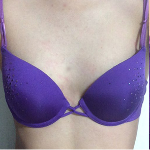 昆山百達麗醫(yī)療美容門診部醫(yī)生周嬡做自體脂肪隆胸怎么樣？附案例效果對比圖