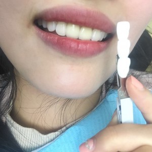 上海科瓦口腔醫(yī)院醫(yī)生鄧建儒做牙齒冷光美白怎么樣？附案例效果對(duì)比圖