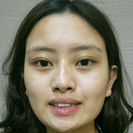 廣州愛來整形醫(yī)院醫(yī)生肖大衛(wèi)做激光點痣怎么樣？附案例效果對比圖