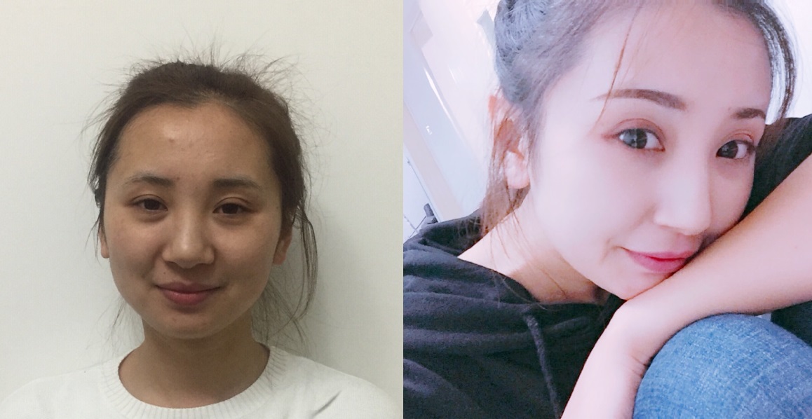 貴陽藝齡醫(yī)療美容門診部醫(yī)生李章做隆鼻手術(shù)怎么樣？附案例效果對比圖