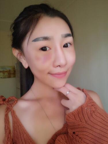 貴陽泰康樂醫(yī)院整形美容科醫(yī)生陳璐做自體脂肪全臉填充效果怎么樣？