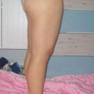 長(zhǎng)沙真愛整形美容醫(yī)院醫(yī)生陳詠玲做大腿吸脂效果怎么樣？