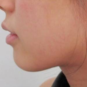 蚌埠韓美美萊整形醫(yī)院醫(yī)生張濤做玻尿酸墊下巴怎么樣？來看案例效果圖