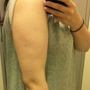 長沙柒和醫(yī)療整形醫(yī)生鐘滔做手臂吸脂怎么樣？附案例效果對(duì)比圖