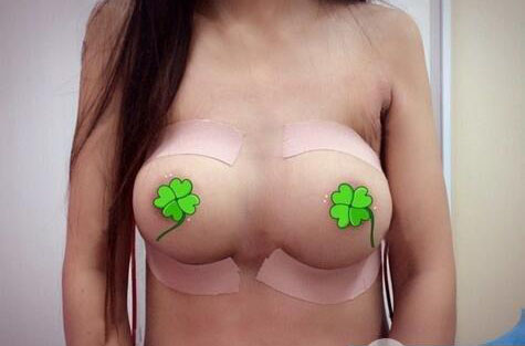 海南伊佳醫(yī)療美容醫(yī)院醫(yī)生涂陽(yáng)君做假體隆胸怎么樣？附案例效果對(duì)比圖