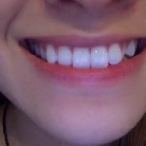 北京美年口腔醫(yī)院醫(yī)生劉海濤做牙齒冷光美白怎么樣？附案例效果對比圖