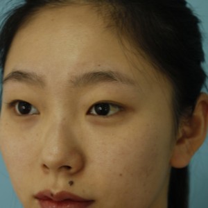 鄭州安格潤整形醫(yī)生楊曉紅做雙眼皮手術(shù)怎么樣？附案例效果圖