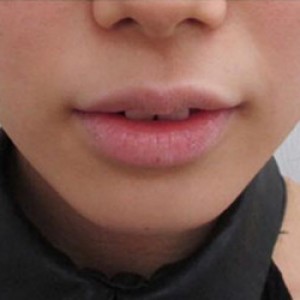 蚌埠韓美美萊整形醫(yī)院醫(yī)生張濤做玻尿酸墊下巴怎么樣？來看案例效果圖