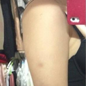 長沙柒和醫(yī)療整形醫(yī)生鐘滔做手臂吸脂怎么樣？附案例效果對(duì)比圖