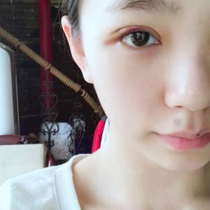 鄭州安格潤整形醫(yī)生楊曉紅做雙眼皮手術(shù)怎么樣？附案例效果圖