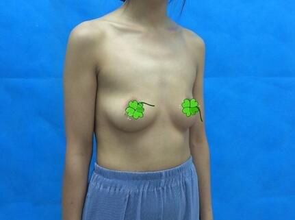 海南伊佳醫(yī)療美容醫(yī)院醫(yī)生涂陽君做假體隆胸怎么樣？附案例效果對比圖