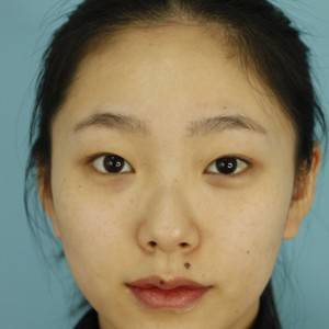 鄭州安格潤整形醫(yī)生楊曉紅做雙眼皮手術(shù)怎么樣？附案例效果圖