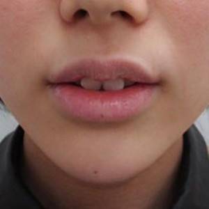 蚌埠韓美美萊整形醫(yī)院醫(yī)生張濤做玻尿酸墊下巴怎么樣？來看案例效果圖