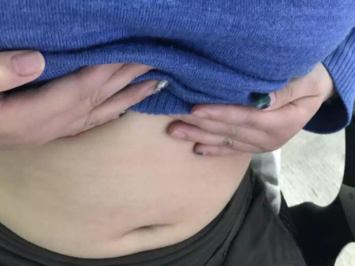 廣州尚美善造美容醫(yī)院醫(yī)生邵方做水動力吸脂怎么樣？附案例效果圖