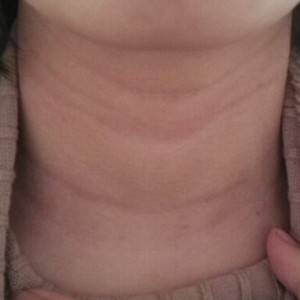 昭通愛麗諾整形醫(yī)生陳志江做嗨體去頸紋怎么樣？附案例效果圖