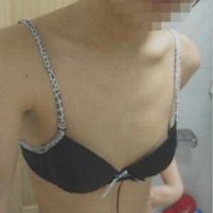 三亞圣迪亞整形美容醫(yī)院醫(yī)生韓超做假體隆胸怎么樣？附案例效果對(duì)比圖