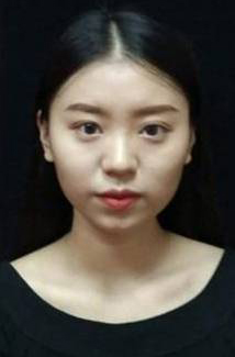 長沙星雅醫(yī)療美容醫(yī)院醫(yī)生陳煥武做埋線提升怎么樣？