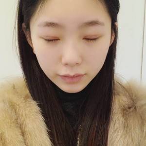 鄭州安格潤整形醫(yī)生楊曉紅做雙眼皮手術(shù)怎么樣？附案例效果圖