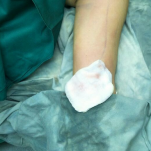 長沙柒和醫(yī)療整形醫(yī)生鐘滔做手臂吸脂怎么樣？附案例效果對(duì)比圖