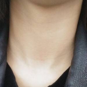 昭通愛麗諾整形醫(yī)生陳志江做嗨體去頸紋怎么樣？附案例效果圖