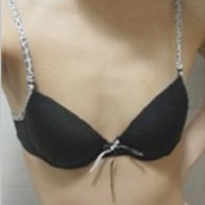 三亞圣迪亞整形美容醫(yī)院醫(yī)生韓超做假體隆胸怎么樣？附案例效果對(duì)比圖