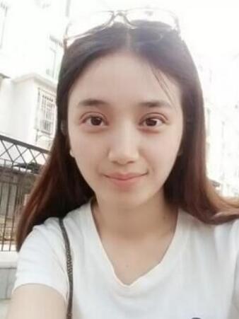 長治松禾醫(yī)療美容診所醫(yī)生馬俊峰做韓式微創(chuàng)定點雙眼皮效果怎么樣？附案例