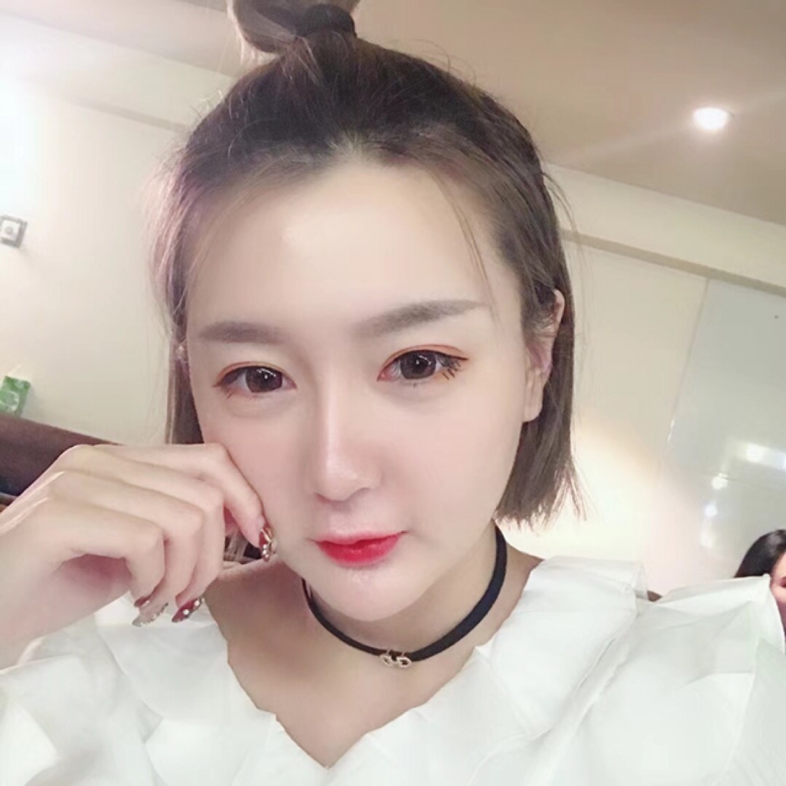 杭州格萊美整形美容醫(yī)院醫(yī)生張霞飛做自體脂肪全臉填充效果怎么樣？