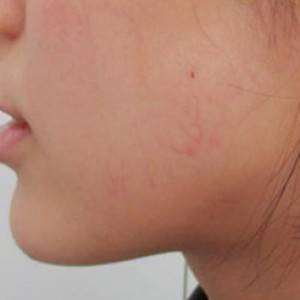 蚌埠韓美美萊整形醫(yī)院醫(yī)生張濤做玻尿酸墊下巴怎么樣？來看案例效果圖