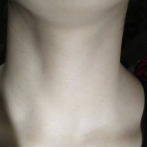 昭通愛麗諾整形醫(yī)生陳志江做嗨體去頸紋怎么樣？附案例效果圖