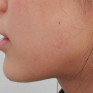 蚌埠韓美美萊整形醫(yī)院醫(yī)生張濤做玻尿酸墊下巴怎么樣？來看案例效果圖