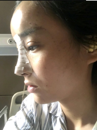 武漢米蘭醫(yī)療美容醫(yī)生柳再億做眼綜合+鼻綜合整形怎么樣？附真實案例對比圖