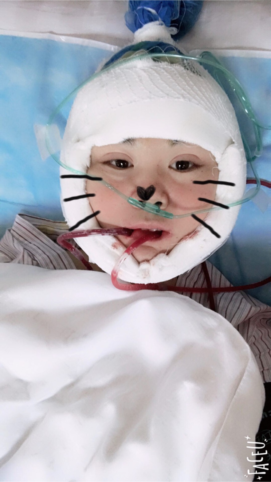 北京彤美美容整形醫(yī)院醫(yī)生楊曉惠做顴骨內(nèi)推+面部吸脂手術(shù)效果怎么樣？附案例