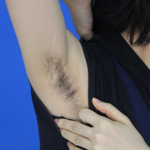 重慶中成整形美容醫(yī)院醫(yī)生田忠成激光脫腋毛效果怎么樣？附案例效果圖