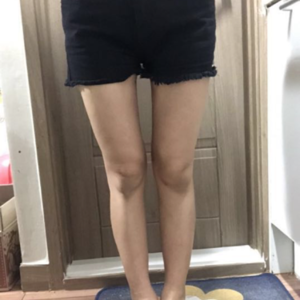 貴陽華美整形美容醫(yī)院醫(yī)生田永華做大腿吸脂效果怎么樣？附大腿吸脂案例前后對比圖