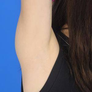 重慶中成整形美容醫(yī)院醫(yī)生田忠成激光脫腋毛效果怎么樣？附案例效果圖