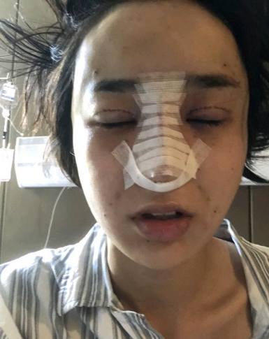 武漢米蘭醫(yī)療美容醫(yī)生柳再億做眼綜合+鼻綜合整形怎么樣？附真實案例對比圖