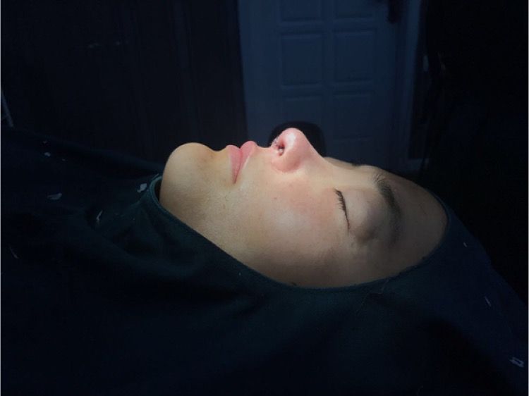 北京集美名媛醫(yī)療整形醫(yī)生陳瀅雯做自體耳軟骨隆鼻怎么樣？附案例效果圖