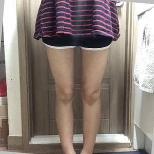 貴陽華美整形美容醫(yī)院醫(yī)生田永華做大腿吸脂效果怎么樣？附大腿吸脂案例前后對比圖