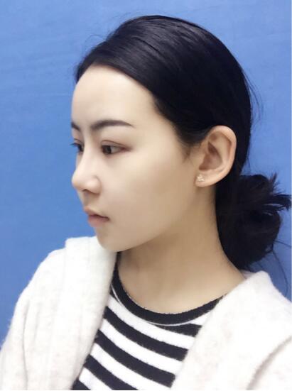 上海時光整形外科醫(yī)院醫(yī)生李靜林做假體隆鼻和反頜手術(shù)怎么樣？