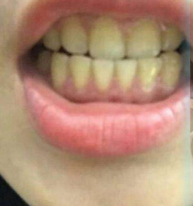 淄博口腔醫(yī)院醫(yī)生牟象鑫做超聲波洗牙怎么樣？附案例效果對(duì)比圖